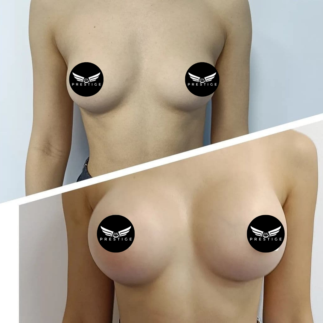 Implant mamar Mentor si Arion