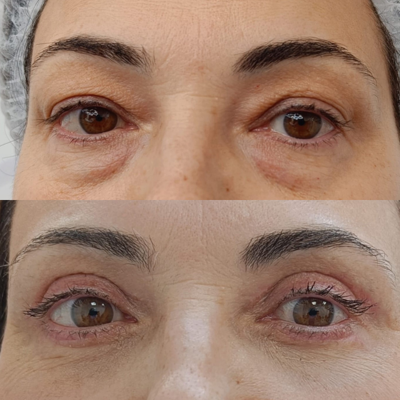 Blefaroplastie