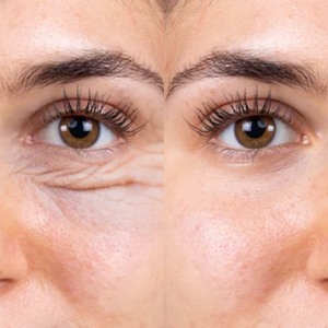 blefaroplastie inferioara Clinica Prestige Bucuresti