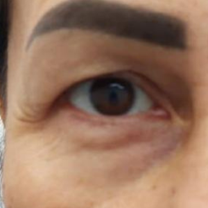 blefaroplastie superioara Clinicile Prestige