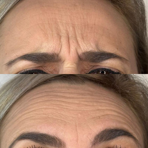 botox Clinica Prestige Bucuresti