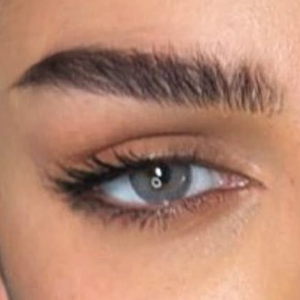 cat eyes cantopexie Clinica Prestige Bucuresti