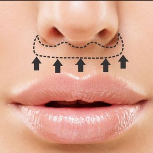 lifting buza superioara Clinica Prestige Bucuresti