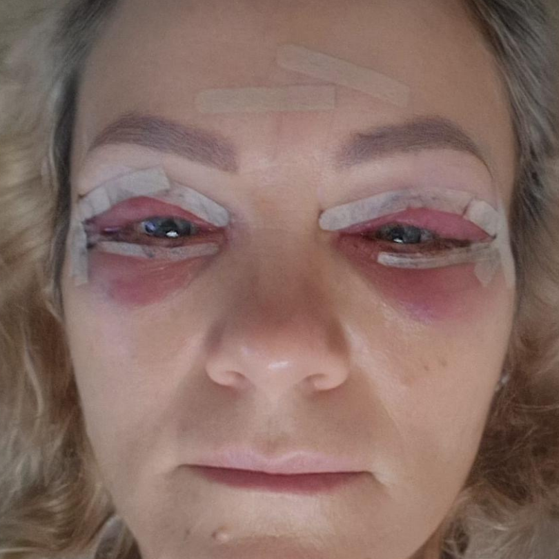 Dupa blefaroplastie