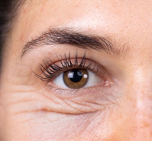 Blefaroplastie inferioara