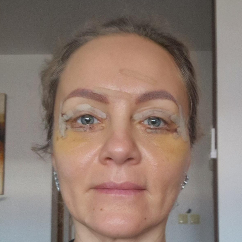 Dupa blefaroplastie