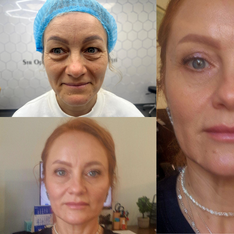 Dupa blefaroplastie