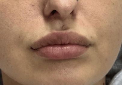 Acid Hialuronic buze 1 ml bucuresti