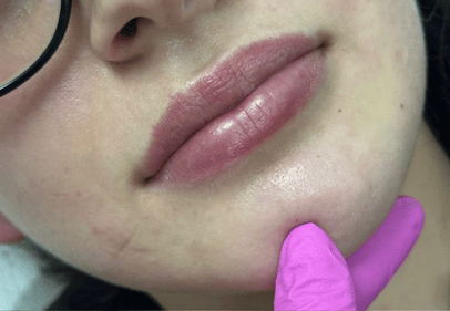 Acid Hialuronic buze 1 ml cluj