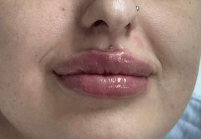 Acid Hialuronic buze 1 ml timisoara