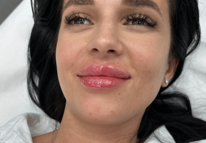 Acid Hialuronic buze 2 ml bucuresti