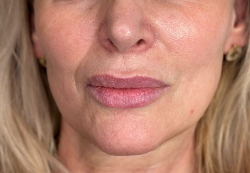 Acid Hialuronic buze 2 ml timisoara-1