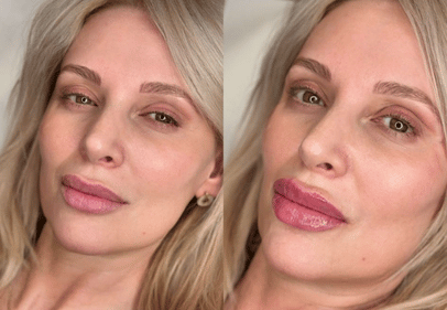 Acid Hialuronic buze 2 ml timisoara