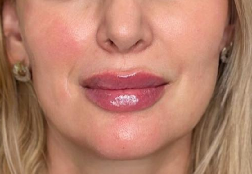 Acid Hialuronic buze 2ml Bucuresti