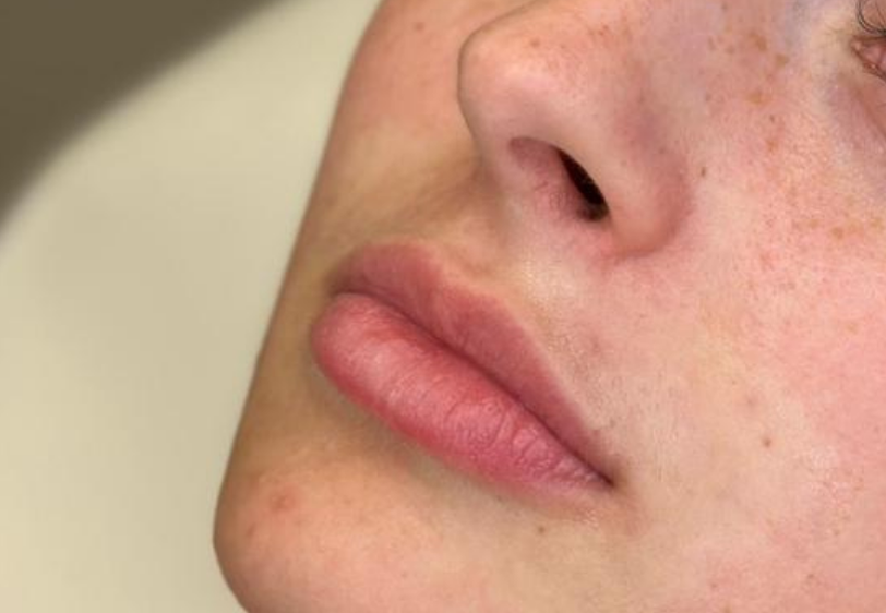 Acid Hialuronic buze bucuresti clinica prestige