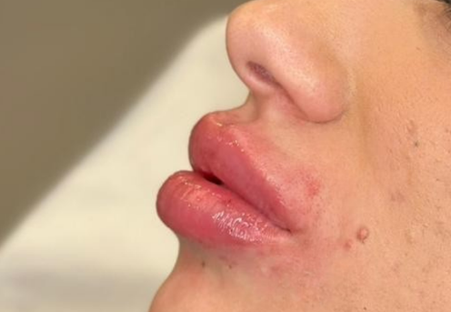 Acid Hialuronic buze cluj clinica prestige-1