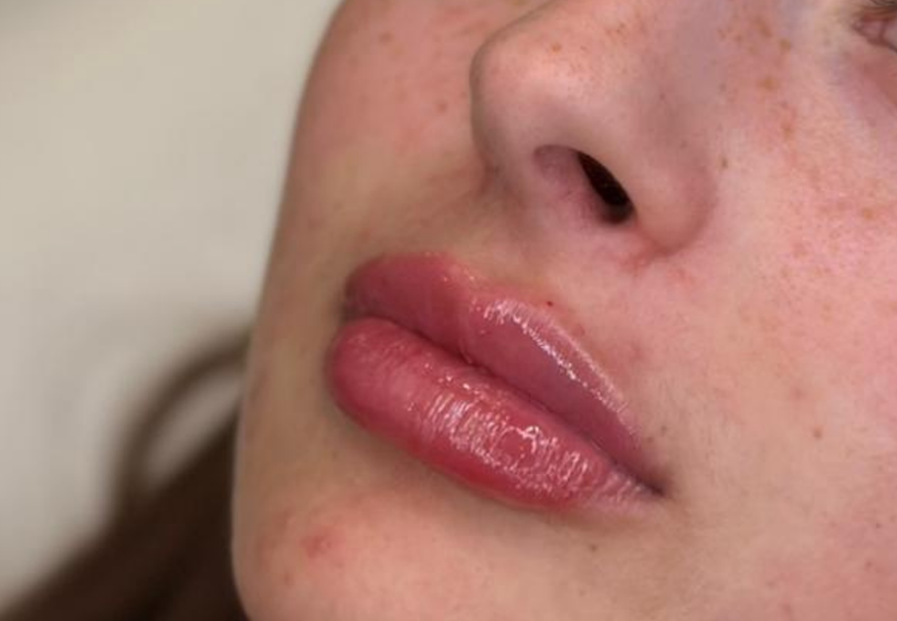 Acid Hialuronic buze timisoara clinica prestige