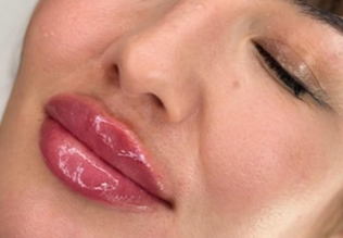 Clinica Prestige Cluj - buze perfecte-1