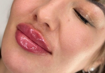 Acid hialuronic Clinica Prestige Cluj