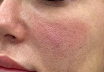 Injectare acid hialuronic cearcane clinica prestige bucuresti