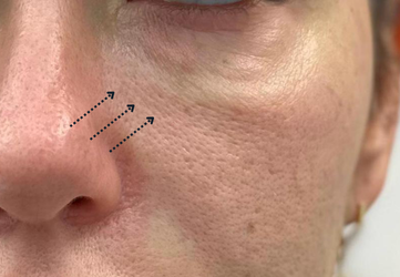 Injectare acid hialuronic cearcane clinica prestige