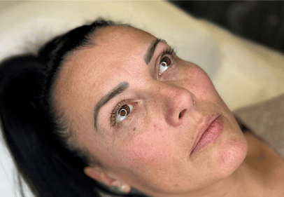 acid hialuronic Cluj