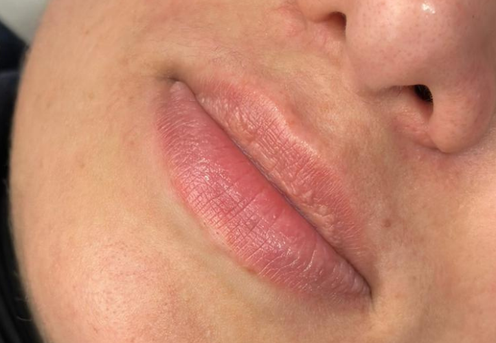 acid hialuronic in buze bucuresti clinica prestige-1