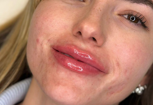 acid hialuronic in buze bucuresti