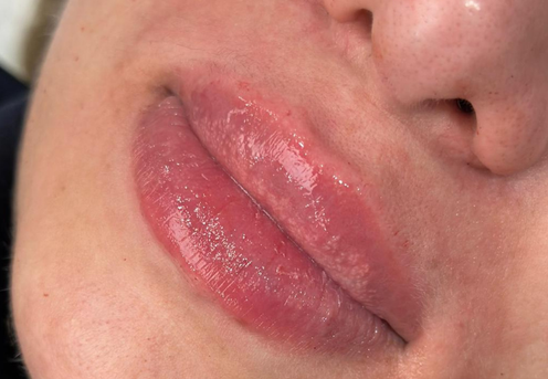 acid hialuronic in buze cluj clinica prestige-1