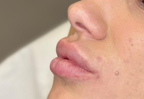 acid hialuronic in buze timisoara clinica prestige-1