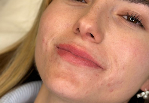 acid hialuronic in buze