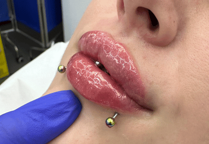 acid hialuronic injectabil