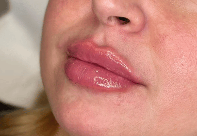 acid hialuronic pret bucuresti