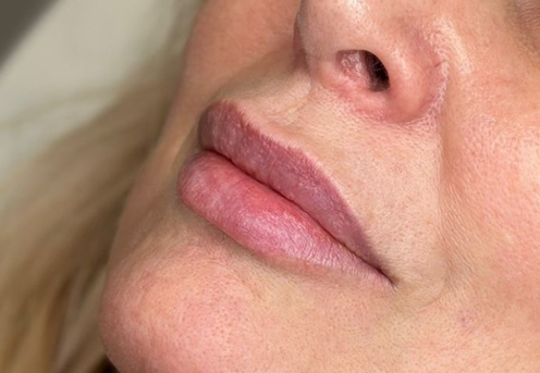 acid hialuronic pret cluj