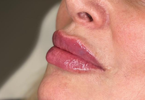 acid hialuronic pret timisoara