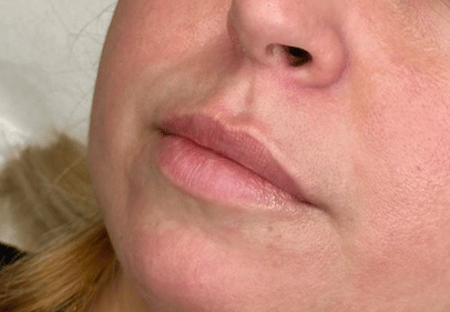 acid hialuronic pret