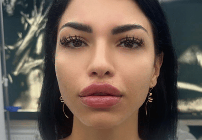 acid hialuronic revox bucuresti