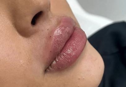 acid hialuronic the ordinary