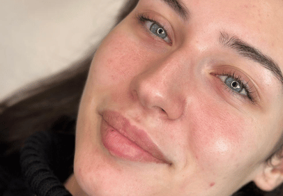 acid in buze bucuresti