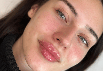 acid in buze timisoara