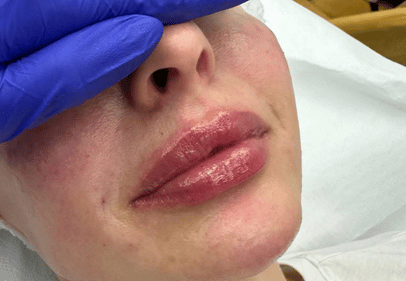 augmentare buze cluj