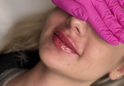 augmentare buze timisoara