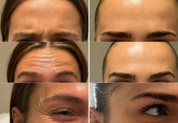 botox 3 zone clinica prestige