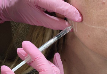 botox bruxism clinica prestige