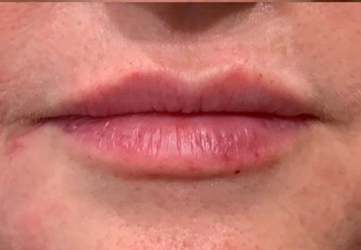 botox colturi buze clinica prestige cluj