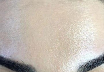 botox frunte clinica prestige bucuresti