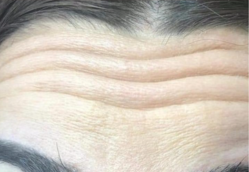 botox frunte clinica prestige