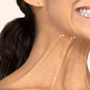 botox platismal