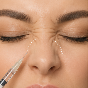 bunny lines botox
