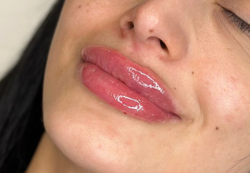 buze acid hialuronic bucuresti-1